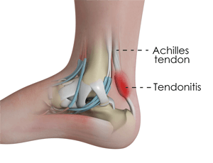 Achilles Tendinitis