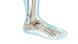 Achilles Tendon Rupture