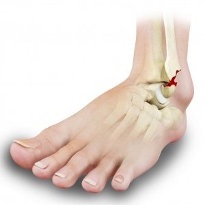 Ankle fracture