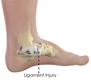  Ankle Ligament Injury   