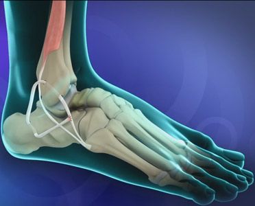 Ankle Sprain & Fracture Surgeries