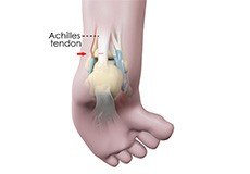 Ankle Tenotomy