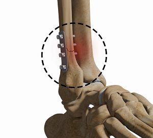 Complex Foot and Ankle Surgeries