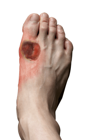 Diabetic Foot Conditions   