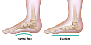 Flatfoot   