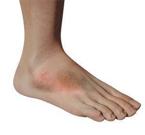  Foot Inflammation   