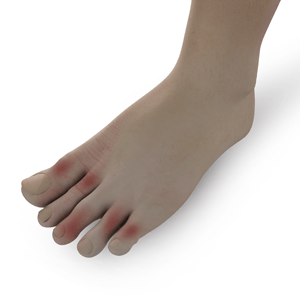  Foot Lesions   