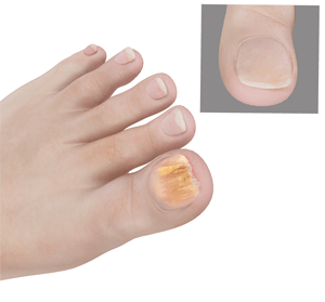 Fungal Nails