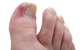 Ingrown toenail   