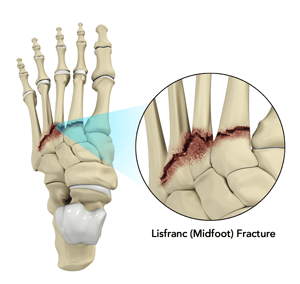  Lisfranc (Midfoot) Fracture   