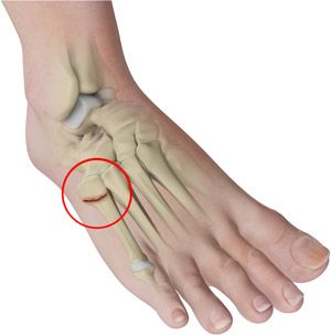 Metatarsal Surgery