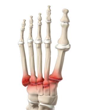 Midfoot Arthritis   