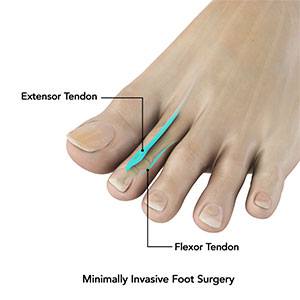 Minimally Invasive Bunion Surgery