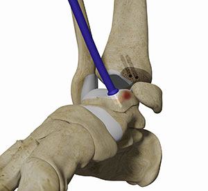   Osteochondral Allograft Transplantation System (OATS) of the Ankle  