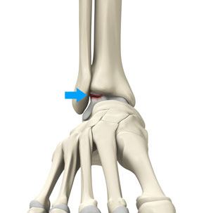 Osteochondral Injuries