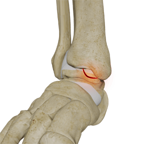 Osteochondral Lesions (OCL) of the Ankle