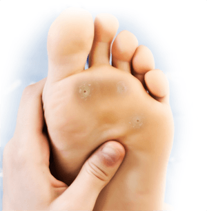 Plantar Warts   