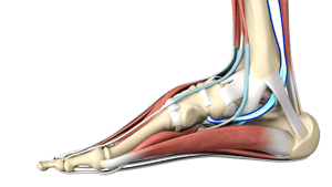 Posterior Tibial Tendon Dysfunction