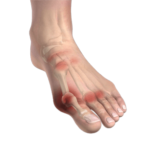 Ankle Rheumatoid Arthritis   