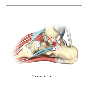 Ankle Sprain El Paso | Ankle Ligament Tear | Twisted Ankle El Paso