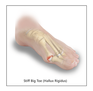 Stiff Big Toe