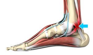 Tarsal Tunnel Syndrome