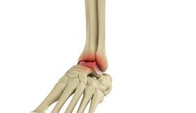      Treatment of Foot and Ankle Arthritis     