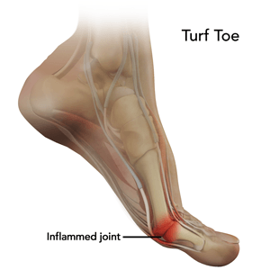  Turf Toe   